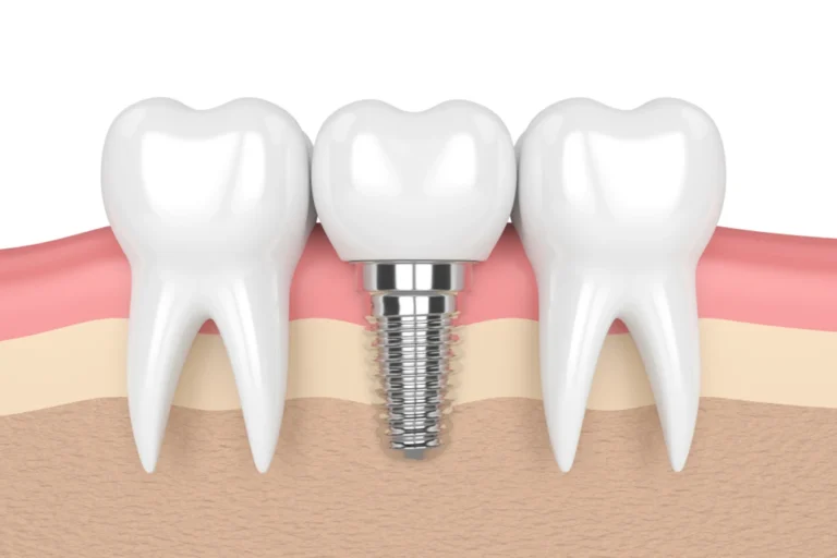 Implant Dentistr